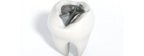 Amalgams and dental alloys